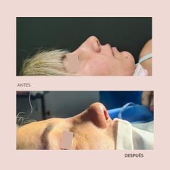 Rinoplastia - Dra. Paola León