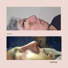Rinoplastia - Dra. Paola León