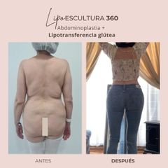 Lipoescultura - Dra. Paola León