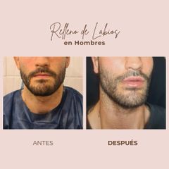 Relleno de labios - Dra. Paola León