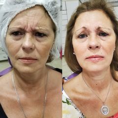 Botox - Dra. Cristina G. Lazarte