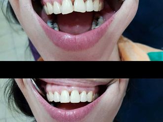 Carillas dentales - 786563