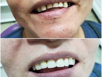 Carillas dentales - 810435