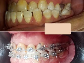 Ortodoncia antes y después - 874460