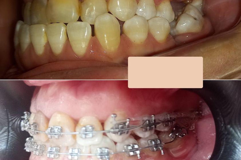 Ortodoncia antes y después - 874460