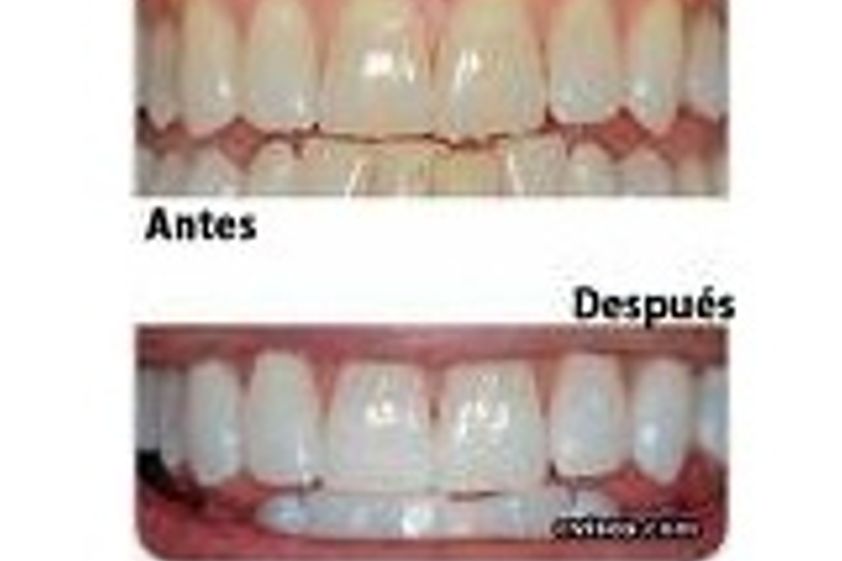 Blanqueamiento dental antes y después - 267690