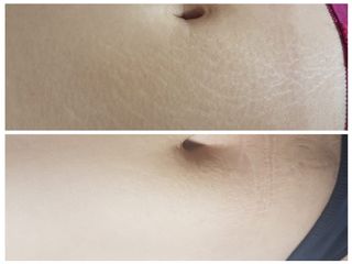 Camuflaje de estrías de abdomen 