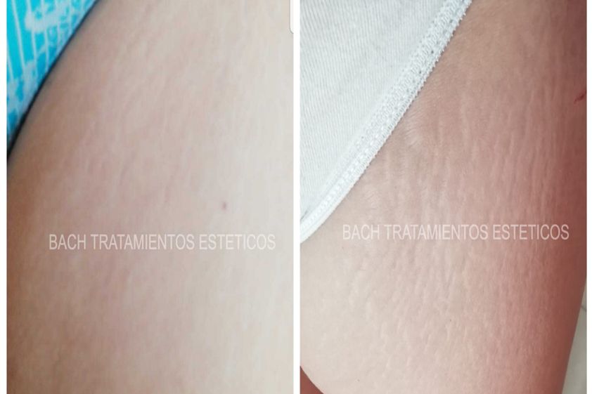 Tratamientos para estrías antes y después - 641942