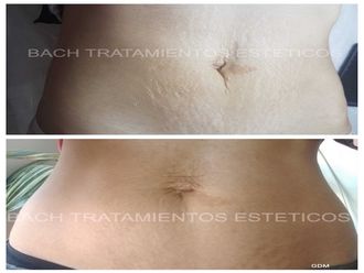 Tratamientos para estrías antes y después - 641943