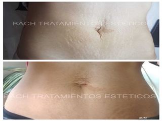 Camuflaje de estrías de abdomen 