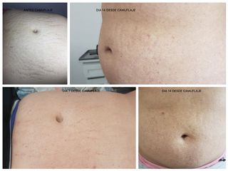 Camuflaje de estrías de abdomen 