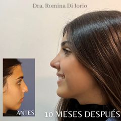 Rinoplastia - Di Iorio - Cajelli