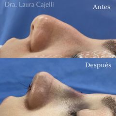 Rinoplastia - Di Iorio - Cajelli