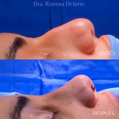 Rinoplastia - Di Iorio - Cajelli