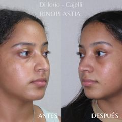 Rinoplastia - Di Iorio - Cajelli