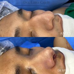 Rinoplastia - Di Iorio - Cajelli