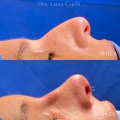 Rinoplastia - Di Iorio - Cajelli