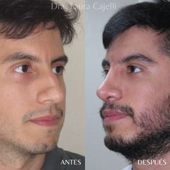 Rinoplastia - Di Iorio - Cajelli