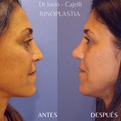 Rinoplastia - Di Iorio - Cajelli