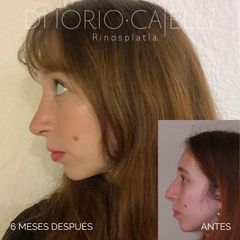 Rinoplastia - Di Iorio - Cajelli