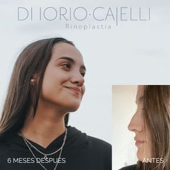 Rinoplastia - Di Iorio - Cajelli