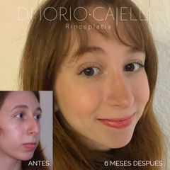 Rinoplastia - Di Iorio - Cajelli