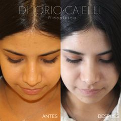 Rinoplastia - Di Iorio - Cajelli