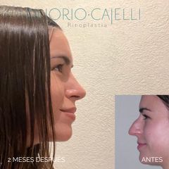 Rinoplastia - Di Iorio - Cajelli