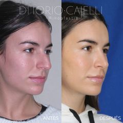 Rinoplastia - Di Iorio - Cajelli