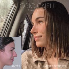 Rinoplastia - Di Iorio - Cajelli