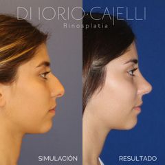 Rinoplastia - Di Iorio - Cajelli