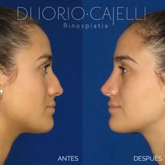 Rinoplastia - Di Iorio - Cajelli