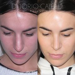 Rinoplastia - Di Iorio - Cajelli