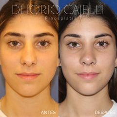 Rinoplastia - Di Iorio - Cajelli