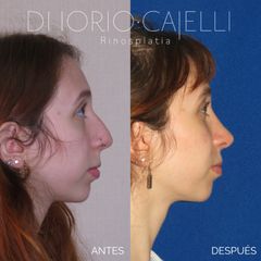 Rinoplastia - Di Iorio - Cajelli