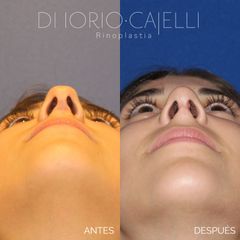 Rinoplastia - Di Iorio - Cajelli