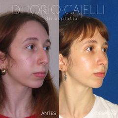 Rinoplastia - Di Iorio - Cajelli