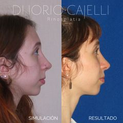 Rinoplastia - Di Iorio - Cajelli