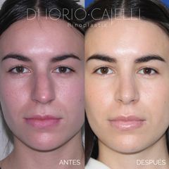 Rinoplastia - Di Iorio - Cajelli