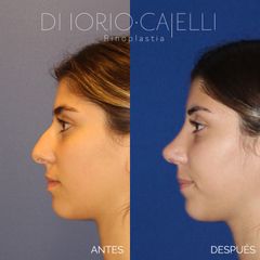 Rinoplastia - Di Iorio - Cajelli