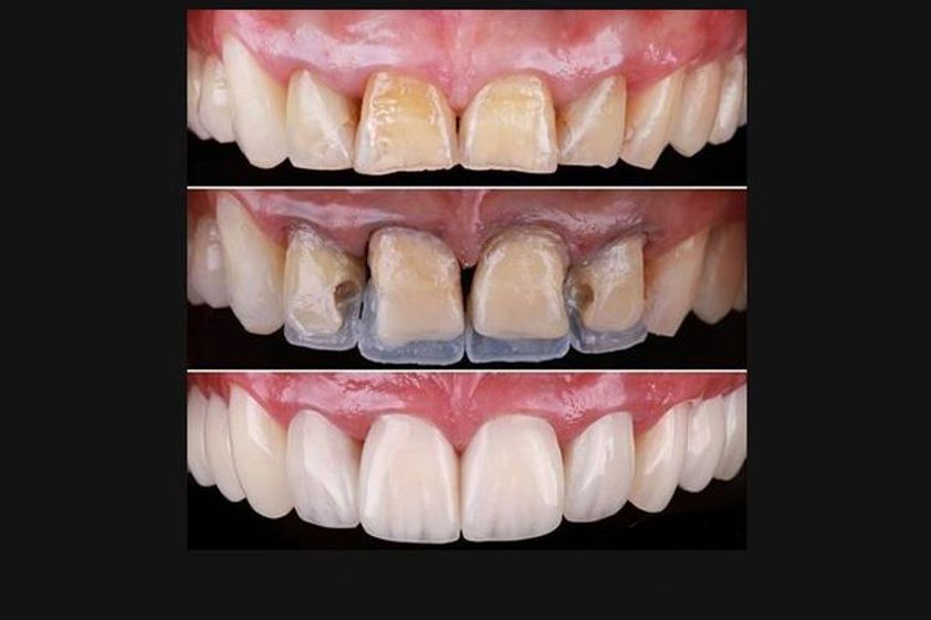 Ortodoncia antes y después - 645345