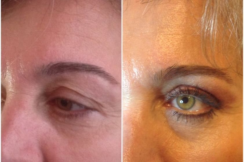 Blefaroplastia antes y después - 598066