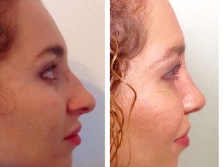 Rinoplastia Estética y Funcional 