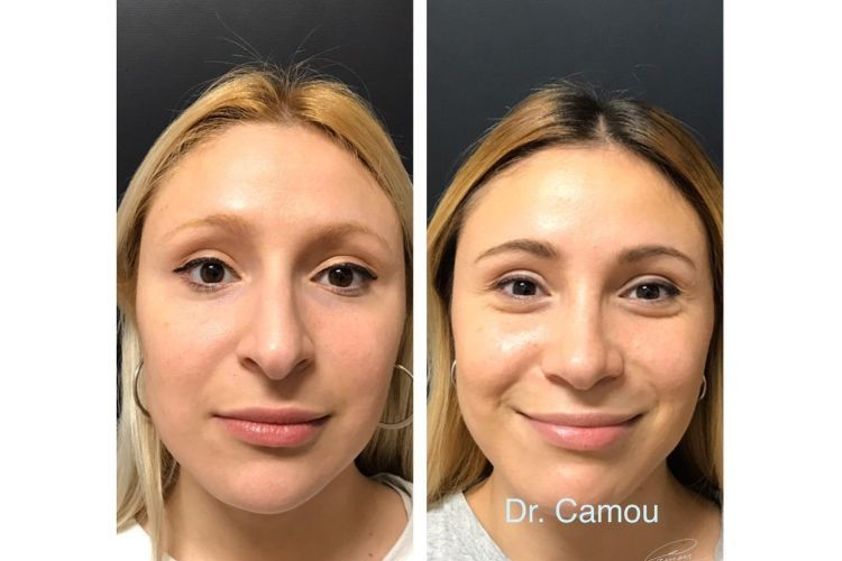 Microblading antes y después - 650500