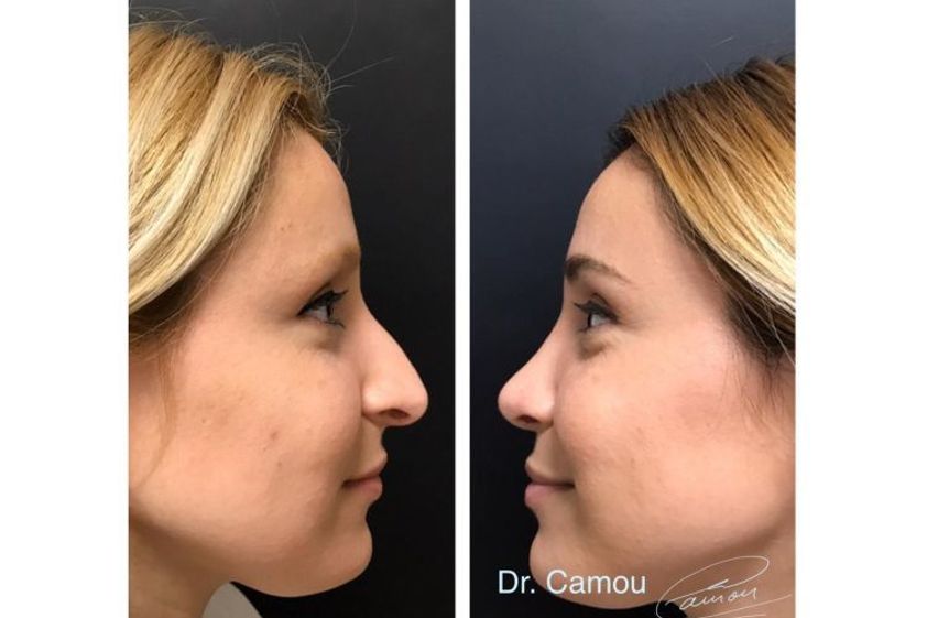 Microblading antes y después - 650501