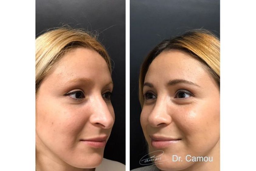 Microblading antes y después - 650502