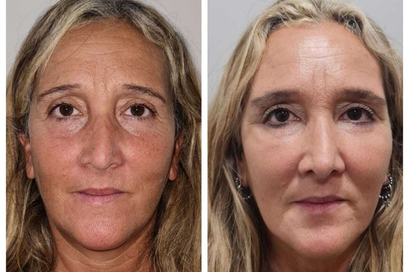 Rellenos faciales antes y después - 825782