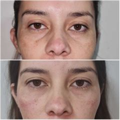 Rellenos faciales - Dr. Juan Ignacio Balestrelli