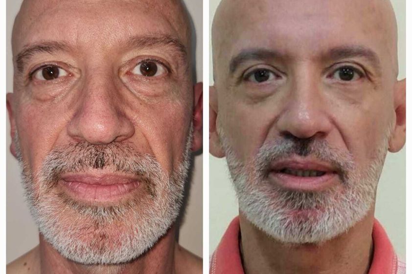 Rellenos faciales antes y después - 825784
