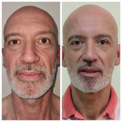 Rellenos faciales - Dr. Juan Ignacio Balestrelli